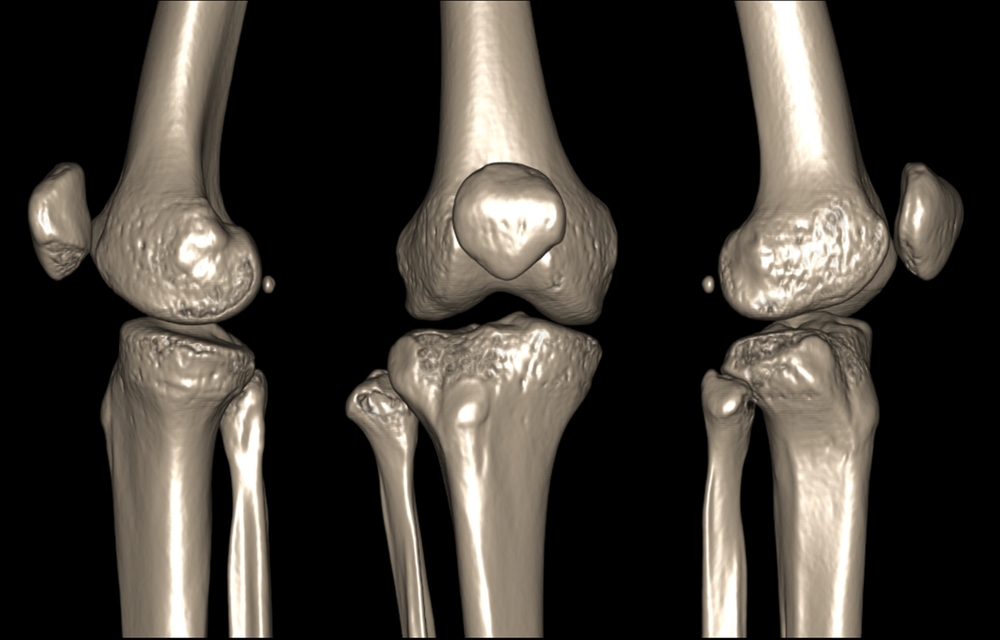 Considering knee surgery? Read this first