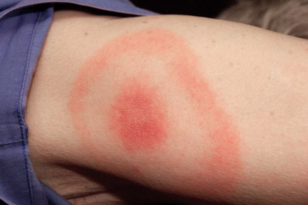 Lyme disease Lyme disease is a bacterial infection that can be spread to humans by infected ticks. It's usually easier to treat if it's diagnosed early. Symptoms of Lyme disease A circular or oval shape rash around a tick bite can be an early symptom of Lyme disease in some people. The rash can appear up to 3 months after being bitten by an infected tick, but usually appears within 1 to 4 weeks. It can last for several weeks. The rash can have a darker or lighter area in the centre and might gradually spread. It's not usually hot or itchy. The rash may be flat, or slightly raised, and look pink, red, or purple when it appears on white skin. It can be harder to see the rash on brown and black skin and it may look like a bruise. A round, red area, surrounded by a red, ring-shape rash, from Lyme disease. Shown on white skin. The rash may look like a bullseye on a dartboard. Credit: CDC/SCIENCE PHOTO LIBRARY https://www.sciencephoto.com/media/95650/view A round, red rash with a slightly darker centre, on the upper arm, caused by Lyme disease. Shown on white skin. Sometimes the edges of the rash may feel slightly raised. Credit: LARRY MULVEHILL/SCIENCE PHOTO LIBRARY https://www.sciencephoto.com/media/259371/view A round, raised rash with a slightly darker centre, on the upper arm, caused by Lyme disease. Shown on black skin. The rash can be less obvious on black or brown skin, and may look more like a bruise. Credit: Lyme Disease Research Center at Johns Hopkins University: https://www.hopkinslyme.org/ Some people also get flu-like symptoms a few days or weeks after they were bitten by an infected tick, such as: a high temperature, or feeling hot and shivery headache muscle and joint pain tiredness and loss of energy Other symptoms of Lyme disease The chance of getting Lyme disease Not all ticks in England carry the bacteria that causes Lyme disease. But it's still important to be aware of ticks and to safely remove them as soon as possible, just in case. Ticks that may cause Lyme disease are found all over the UK, but high-risk places include grassy and wooded areas in southern and northern England and the Scottish Highlands.